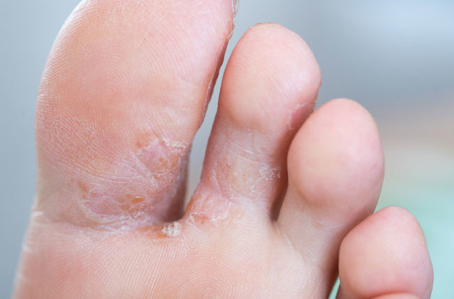 Tinea Pedis